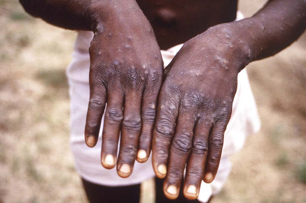 WHO considers declaring monkeypox a global health emergency